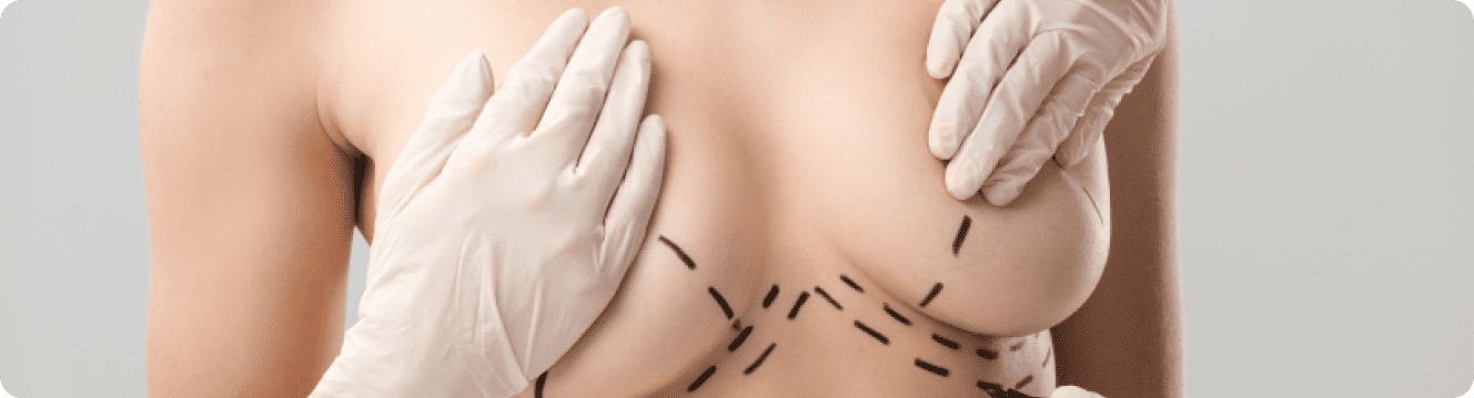 marking breast for surgery